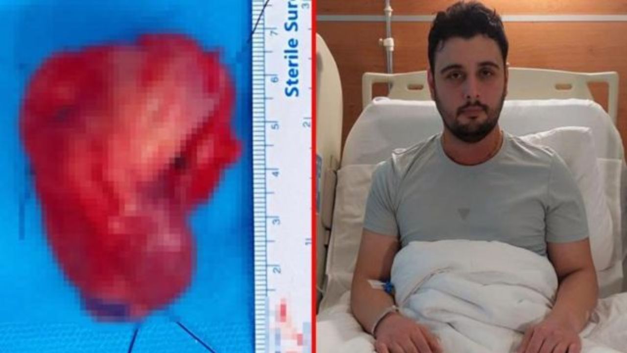 Çürük dişini önemsemeyen genç adam hızla yayılan dil kanserine yakalandı