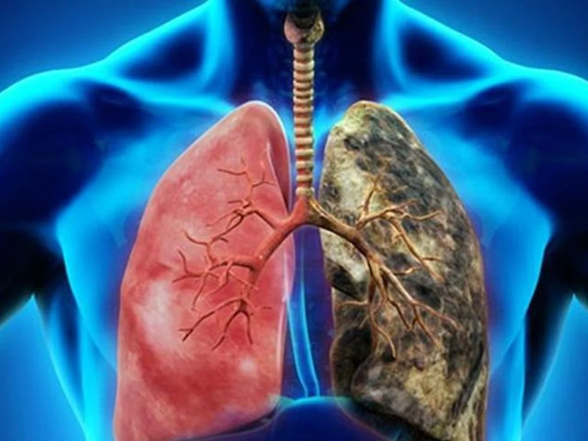 Hemoptizi olarak adlandırılan ve akciğer kanserinin en sık görülen semptomlarından biri olan kan tükürmek, akciğer kanserine işaret ediyor.
