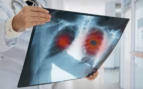 Sağlık alanında yaşanan son gelişmeler sayesinde, akciğer kanseri erken evrede tespit edilebiliyor ve hastanın uzun yaşam şansı artıyor.